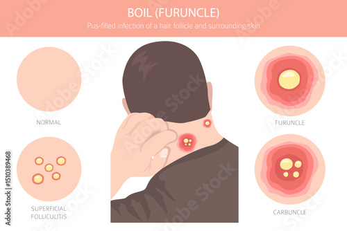 Boil, Furuncle, carbuncle. Skin diseases. Medical infographic design. Vector illustration