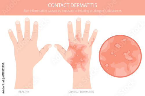 Contact dermatitis. Skin diseases. Medical infographic design. Vector illustration