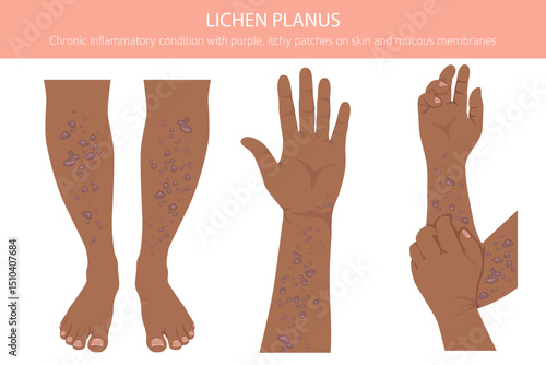 Lichen Planus. Skin diseases. Medical infographic design. Vector illustration