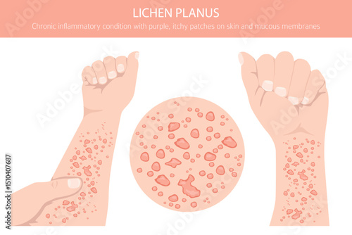 Lichen Planus. Skin diseases. Medical infographic design. Vector illustration