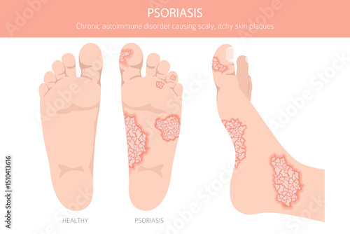 Psoriasis. Skin diseases. Medical infographic design. Vector illustration