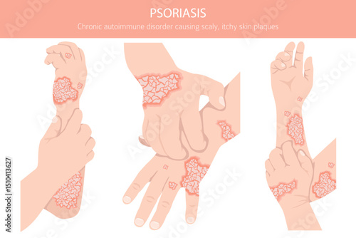 Psoriasis. Skin diseases. Medical infographic design. Vector illustration