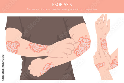 Psoriasis. Skin diseases. Medical infographic design. Vector illustration