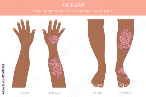 Psoriasis. Skin diseases. Medical infographic design. Vector illustration