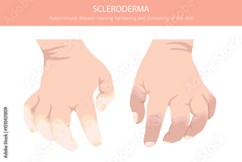 Scleroderma. Skin diseases. Medical infographic design. Vector illustration