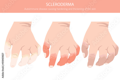 Scleroderma. Skin diseases. Medical infographic design. Vector illustration