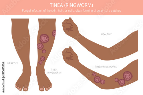 Tinea. Ringworm. Skin diseases. Medical infographic design. Vector illustration