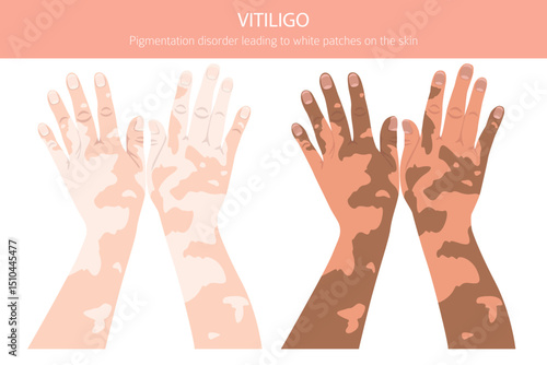 Vitiligo. Skin diseases. Medical infographic design. Vector illustration