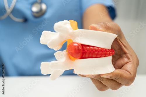 фотографія Asian doctor holding spinal nerve and bone model, Lumbar spine displaced herniated disc fragment for treatment medical in the orthopedic department
