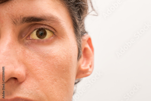 Obraz na płótnie Man with yellow eyes, closeup. Symptom of hepatitis