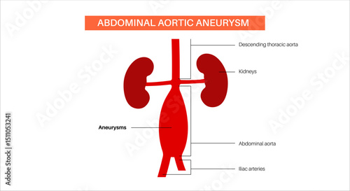 Abdominal Aortic Aneurysm