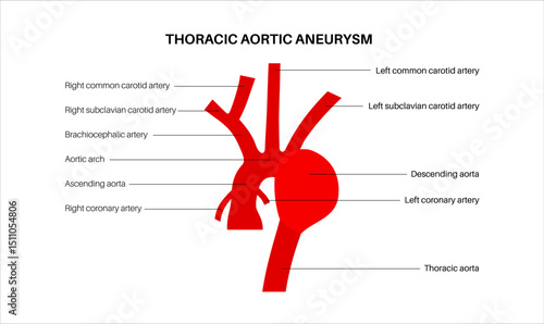 Thoracic aortic aneurysm