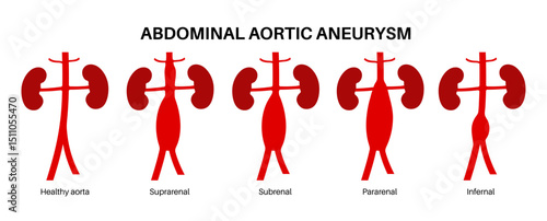Abdominal Aortic Aneurysm