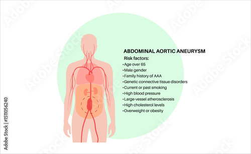 Abdominal Aortic Aneurysm