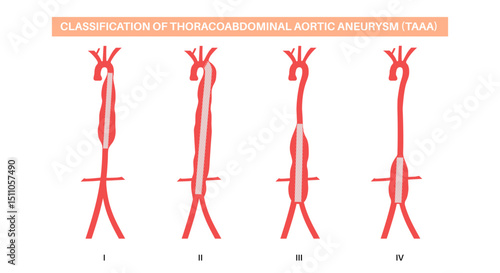 Thoracoabdominal aortic aneurysm surgery