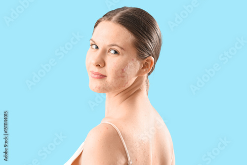 Teenage girl with acne prob...