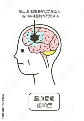 脳血管性認知症によって損傷を受ける脳の部分とその名称のイラスト