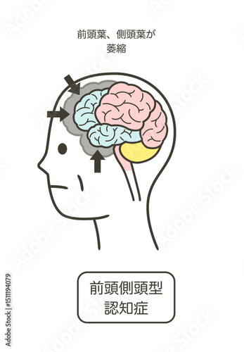 前頭側頭型認知症によって損傷を受ける脳の部分とその名称のイラスト
