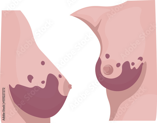 Angiosarcoma is a rare and aggressive malignant tumor originating from the lining of blood vessels or lymphatic vessels.