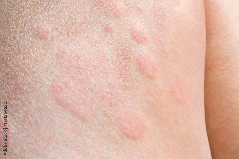 Naklejka premium Young asian man has allergic skin rash on his legs from itchy dry skin eczema dermatitis insect bites