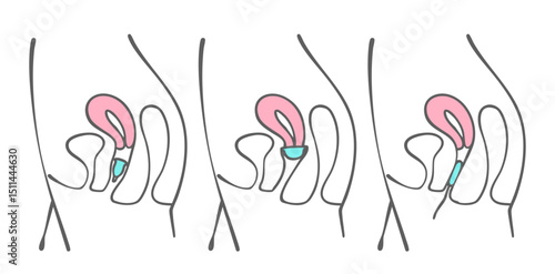 月経カップ、月経ディスク、タンポンの装着位置/Position of menstrual cups, menstrual discs, and tampons