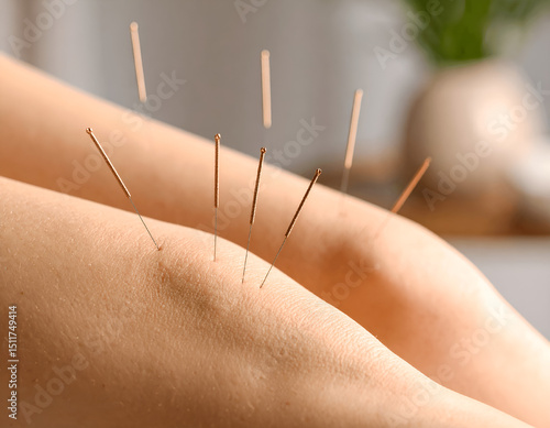 Acupuncture Needles in Knee