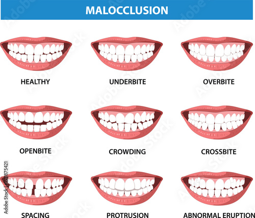 Malocclusion of Human Teeth Vector Illustration (Royalty Free)