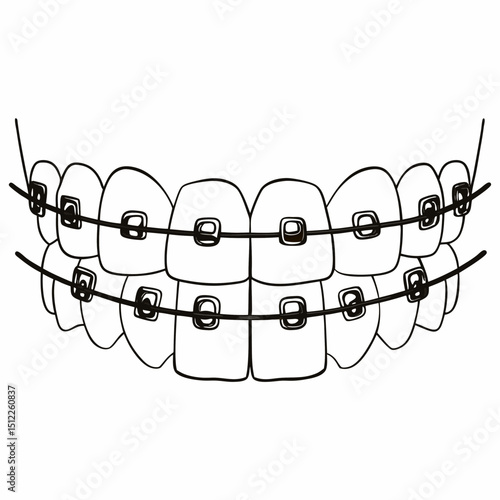 Illustration of orthodontic braces on a smiling teeth alignment  
