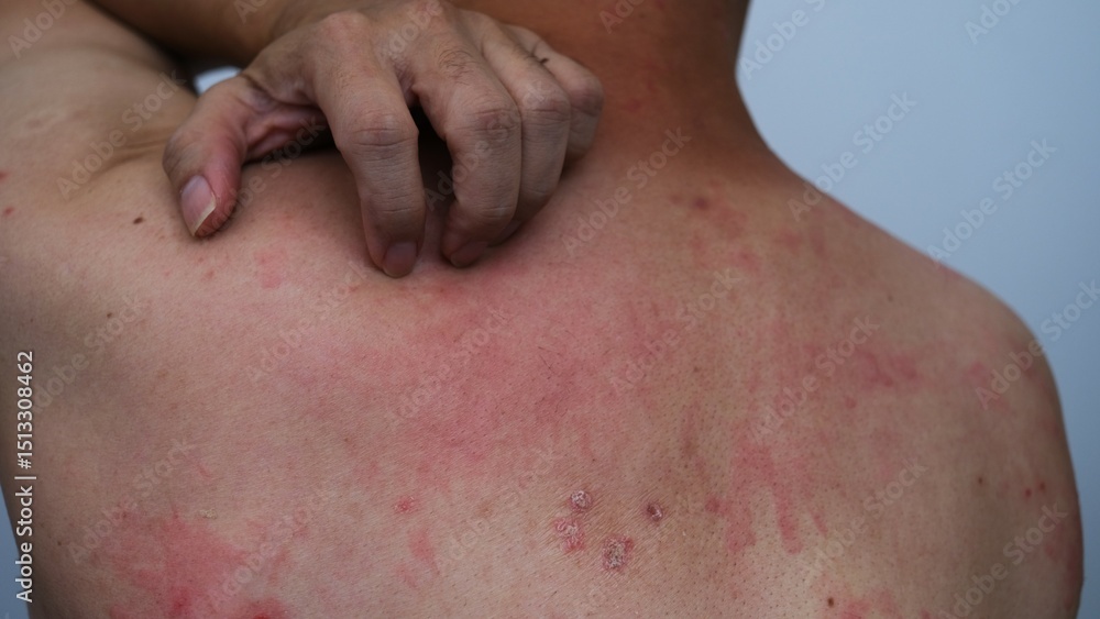 Naklejka premium Close up image of skin texture suffering severe urticaria or hives or kaligata. Allergy symptoms.