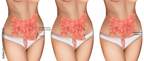 Colon Cancer Surgery Illustration – Tumor Removal and Bowel Reconnection. Medical Diagram of Colon Resection Procedure. Step-by-Step Colorectal Surgery with Tumor Excision and Anastomosis
