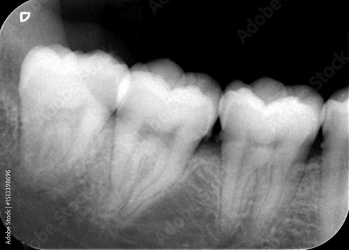 Periapical x-ray showing  impacted wisdom tooth 