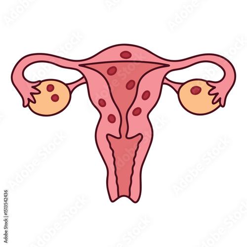 Uterus with endometriosis shown as red lesions outside the uterine lining. Used in gynecology, medical education, and awareness of chronic pelvic condition