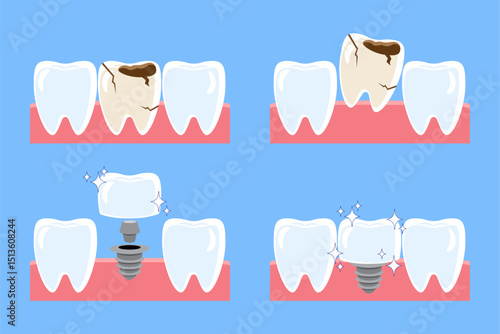 Dental implant procedure installation . Decayed tooth removed and replace by artificial tooth . Flat design cartoon illustration . Isolated on blue background . Vector .
