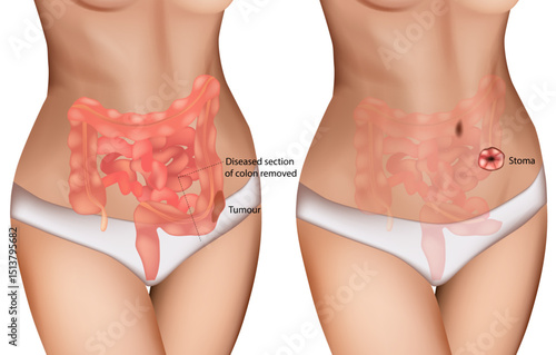 Colon Cancer Surgery and Stoma Formation Medical Illustration. Digestive Tract Tumor Removal with Colostomy Diagram. Colorectal Tumor Resection and Ostomy Procedure Anatomy