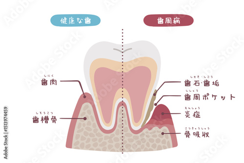 手描きの健康な歯と歯周病の歯の断面図のイラスト