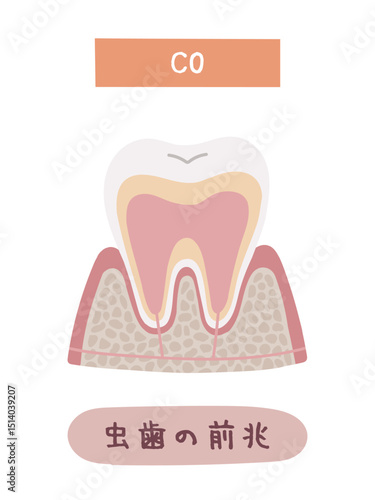 虫歯になる過程のC0のイメージイラスト