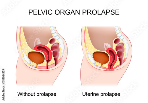 Pelvic organ prolapse. Cross section of female abdomen