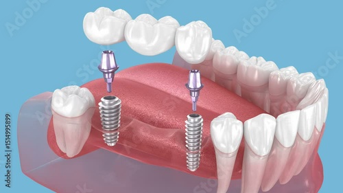 Dental bridge based on two implants. Medically accurate 3D Animation of human teeth and dentures concept