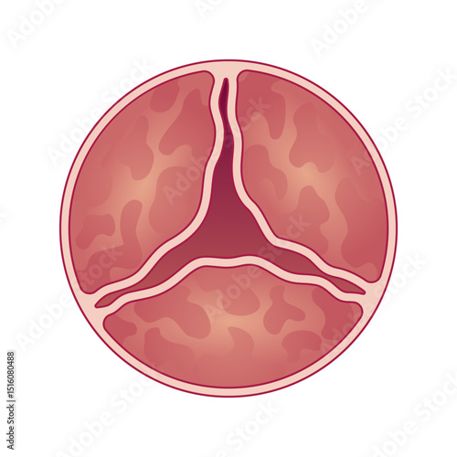 Medical illustration shows aortic valve with stenosis. Vector illustration