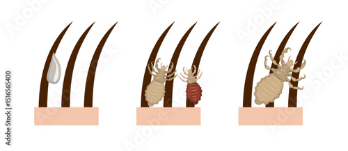 Lice clinging to hair and special medicine dropping on it