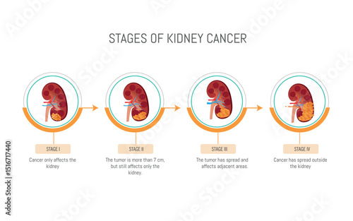 Stages of kidney cancer development showing tumor growth and spread