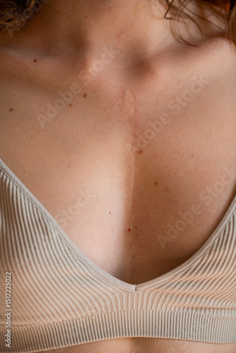 Heart surgery scar on skin of woman close up