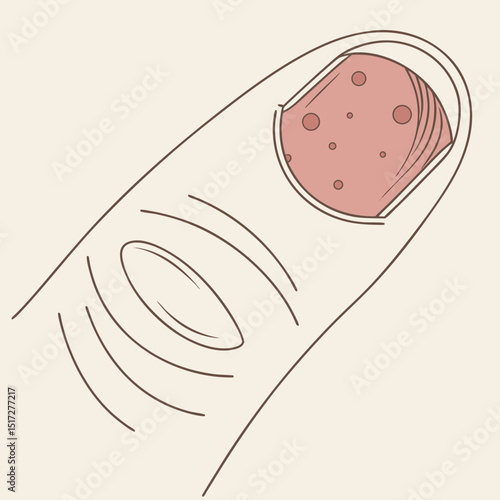Wart on Finger Medical Illustration Vector
