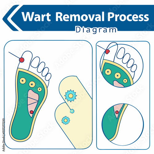 Wart Removal Process Diagram Vector
