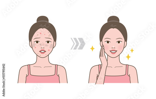 Before and after of cute woman with skin trouble as pimple, blackhead, whitehead, zit, blemish, acne, freckle, papule and woman with clear and clean skin
