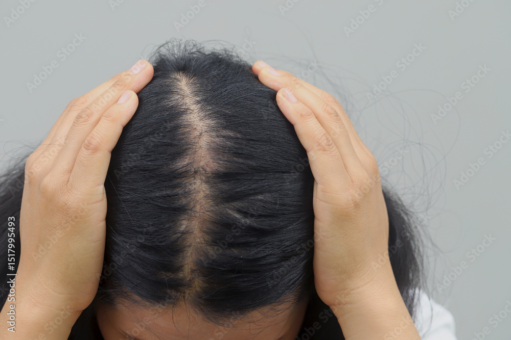 Naklejka premium Women with hair loss dryness and frizziness.