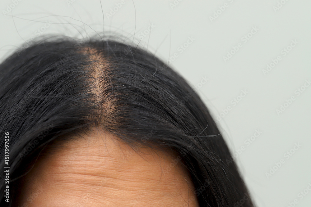 Women with hair loss dryness and frizziness Women with hair loss dryness and frizziness