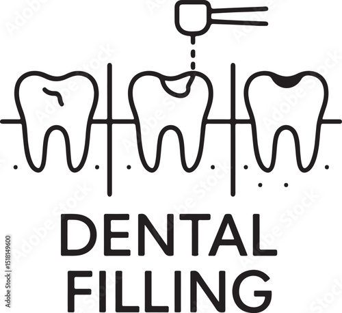 dental filling illustration