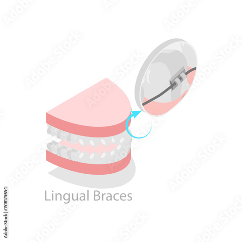 3D Isometric Flat Vector Illustration of Dental Teeth Braces Types, Orthodontic Options for Teeth Straightening. Item 4