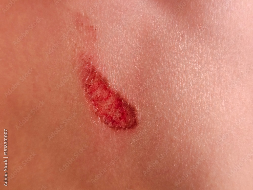 Fototapeta premium Skin injury showing redness and swelling indicating possible abrasion on the body skin surface concept